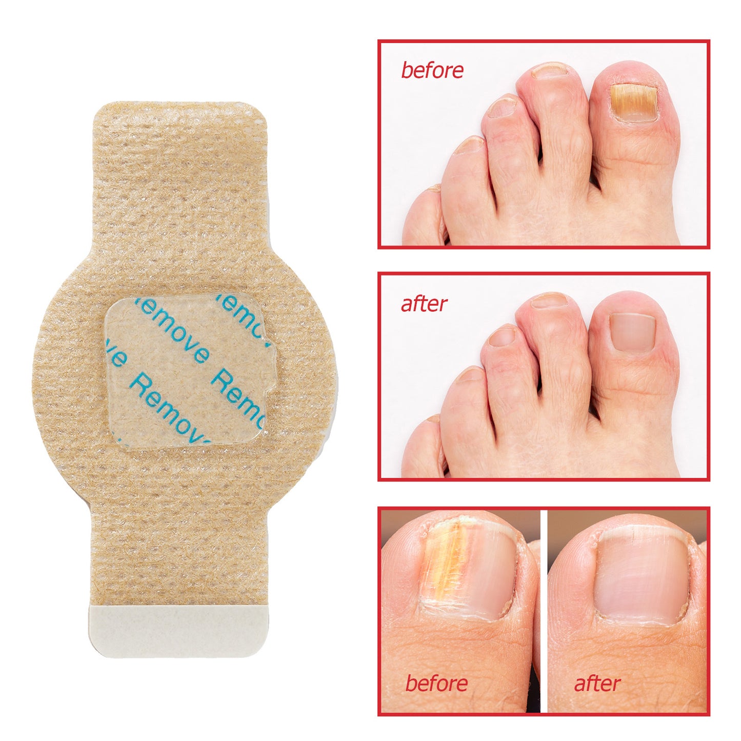 Extra-Strength Hydrogel Overnight Toenail Fungus Patches for Overnight Toenail Repair