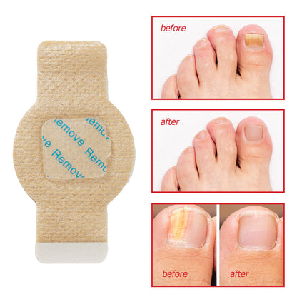 Extra-Strength Hydrogel Overnight Toenail Fungus Patches for Overnight Toenail Repair